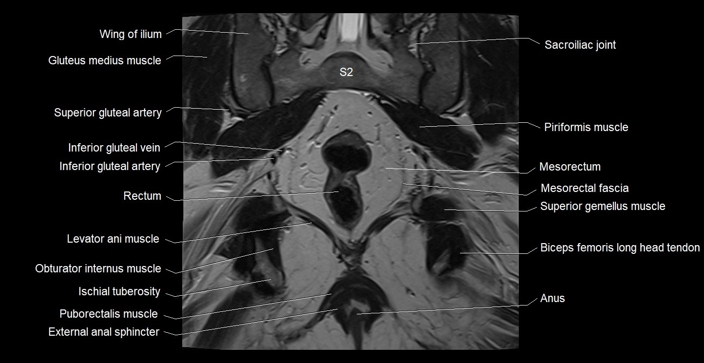 MRI coronal cross sectional anatomy male pelvis image 31.webp